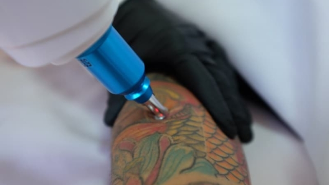 Frequently Asked Questions About Laser Tattoo Removal Procedures