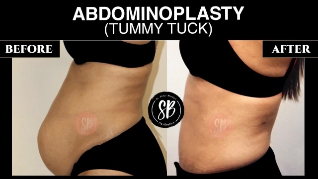 6 Truths About Abdominoplasty: What You Need to Know