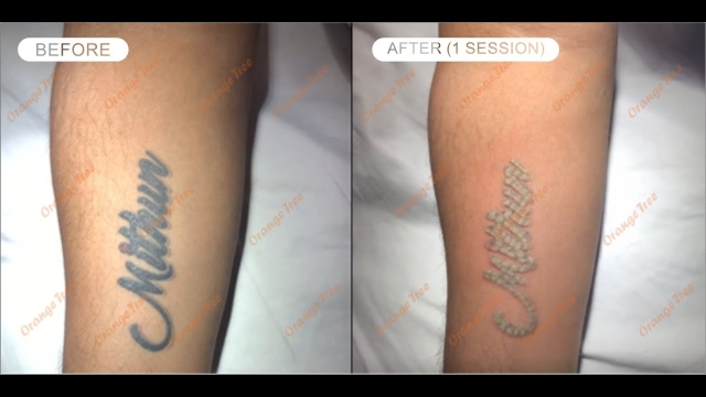 Different Tattoo Removal Methods