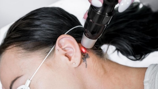 Bad Tattoos Are Increasing – Is Proshape Rx Safe Tattoo Removal