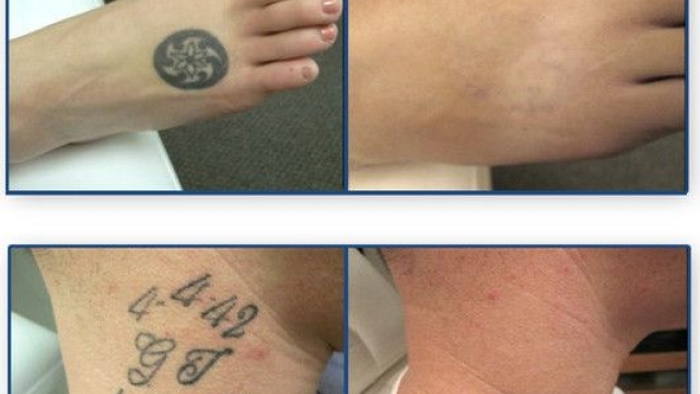 How Much Does Tattoo Removal Cost? Close Your Wallet And Find Out
