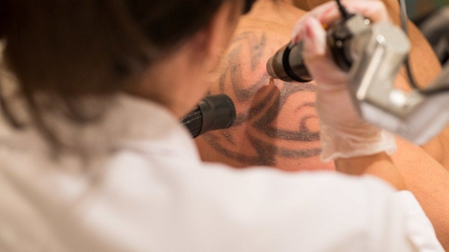 Tattoo Removal Made Easy With Laser Treatments
