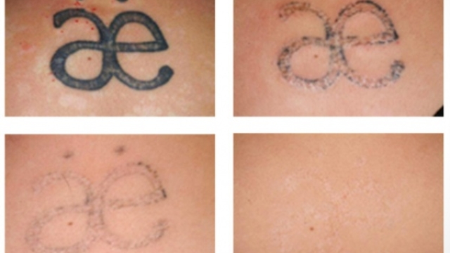 The Associated With Tattoo Removal: Read This And Complications Money